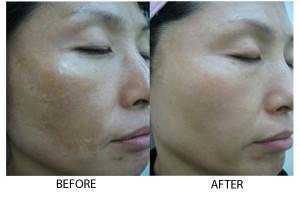 Hyperpigmentation2