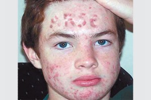 Acne