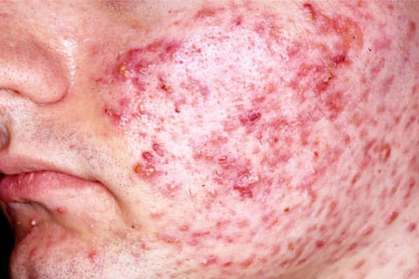 Skin Problems