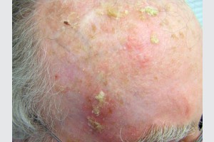 actinic-keratosis