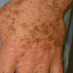 Age Spots on Hand
