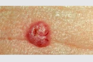 basal-cell-carcinoma