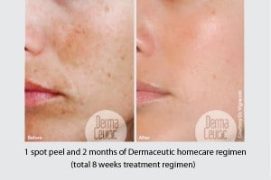 chemical-peel1
