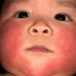 eczema1