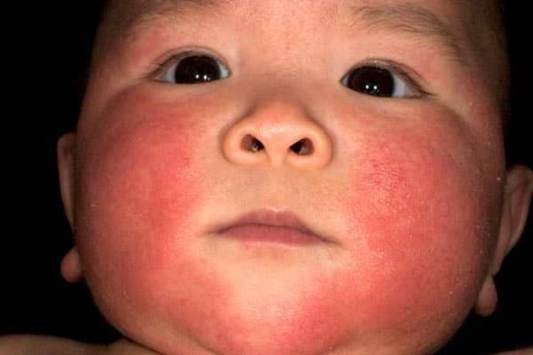 eczema1