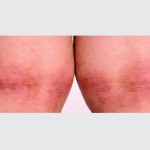 eczema2