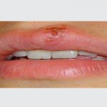 Herpes