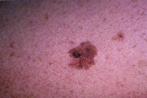 melanoma