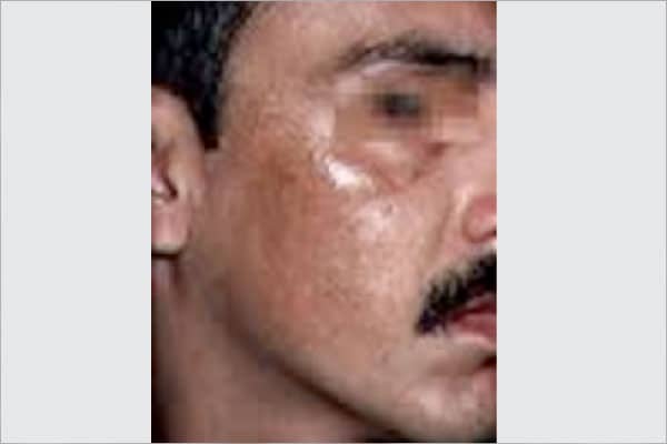 melasma melasma