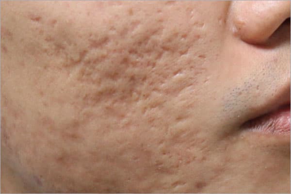 men-acne-scars men acne