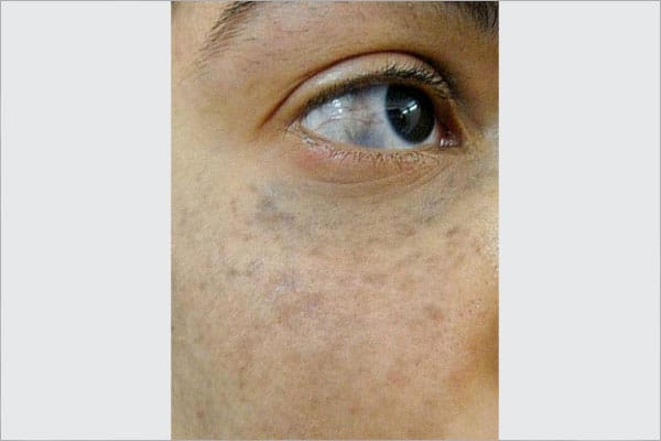 Pigmentary nevus Men Pigmentary Nevus