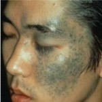 Nevus of Ota