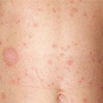 Pityriasis Rosea