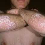 Psoriasis
