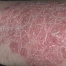 psoriasis1
