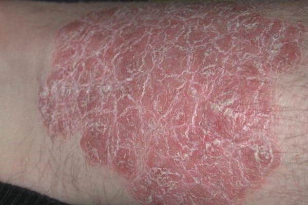 Psoriasis