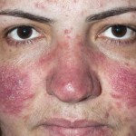 Rosacea
