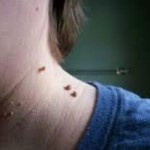 Skin Tags