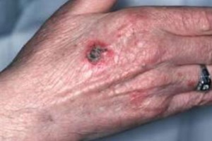 squamous-cell-carcinoma