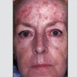 Sun Damage