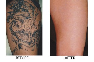 tattoo-removal