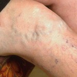 Sclerotherapy Treatment for Varicose Veins