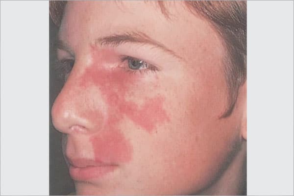 Vascular Nevus