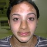 vitiligo-psoriasis1