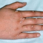 Warts
