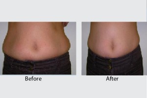mesotherapy-fat2