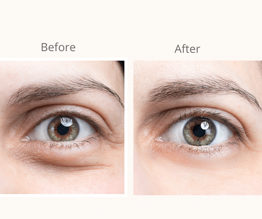 Under eye Fillers2